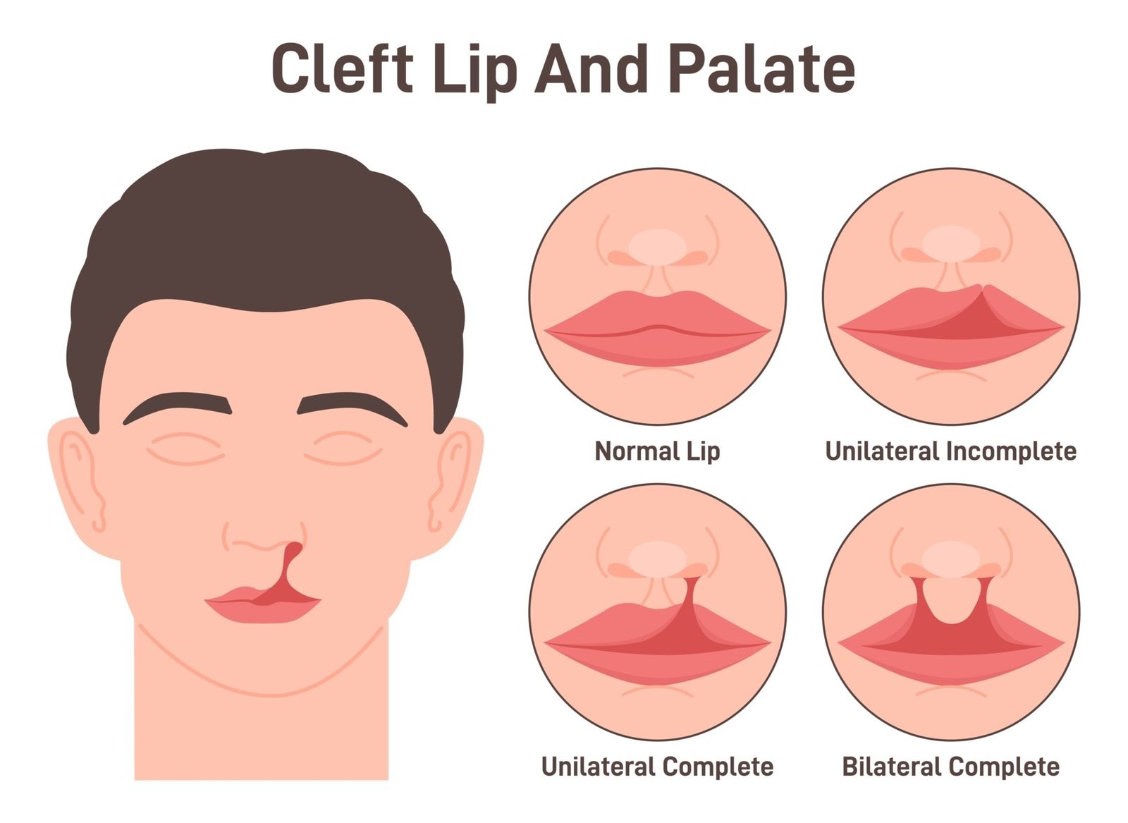 Cleft Lip and Palate Surgery